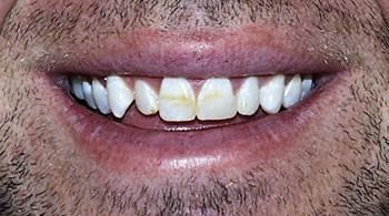 Teeth Bleaching before