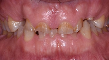 full mouth reconstruction patient 3 before