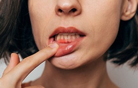 Woman with gum irritation