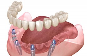 Illustration of all-on-4 dentures
