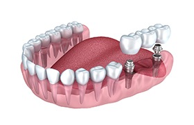 Digital model of an implant-retained bridge. 