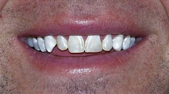 Teeth bleaching after