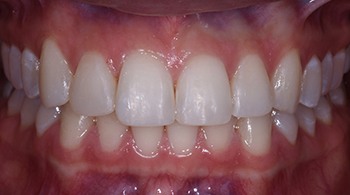 cosmetic bonding patient after