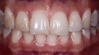 cosmetic bonding patient before