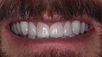 full mouth reconstruction patient 2 after