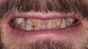 full mouth reconstruction patient 2 before