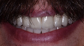 porcelain veneers after