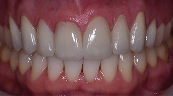 porcelain veneers patient after