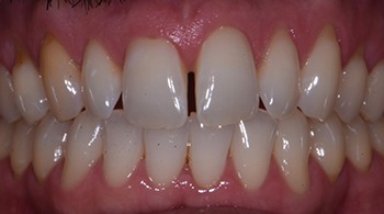 porcelain veneers patient before