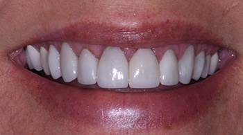 porcelain veneers patient 1 after