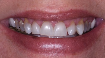 porcelain veneers patient 1 before