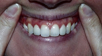 porcelain veneers patient 2 after