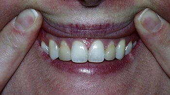 porcelain veneers patient 2 before