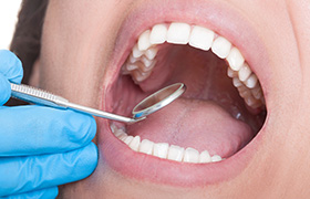 Closeup of teeth being examined