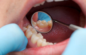 Examination of treated tooth