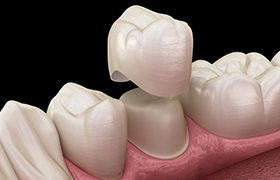 diagram of dental crown being placed over tooth 