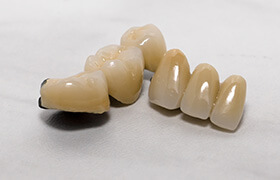 Two custom dental bridges