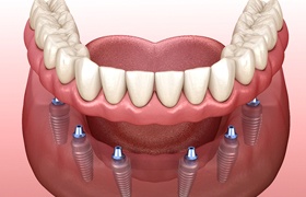 Digital illustration of an implant denture in Aurora