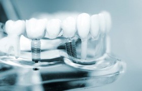 an example of a dental implant bridge