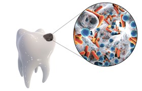 Model of tooth decay infecting a tooth.
