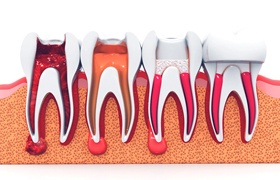 Each step of a root canal. 