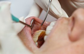 Soft tissue laser dentistry treatment.