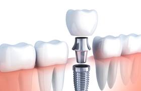 Diagram showing how dental implants work in Aurora