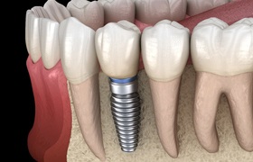 Diagram of an integrated dental implant