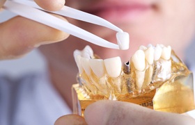 Implant dentist in Aurora placing restoration onto a model