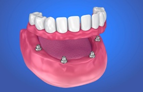 implant-retained denture