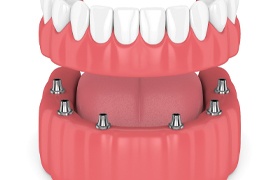 implant-supported denture