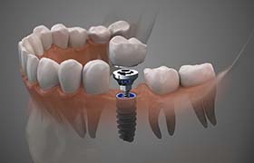 single dental implant in the jaw