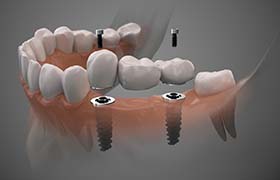 two dental implants supporting a bridge