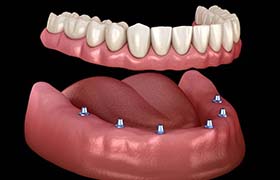 six dental implants supporting a full denture