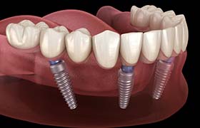 All-on-4 dental implants