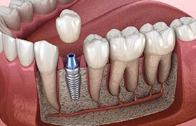 model of a dental implant integrating with the jawbone
