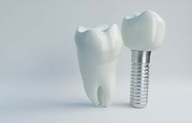model of a dental implant next to a real tooth