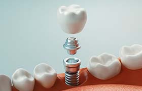 illustration of how dental implants in Aurora work