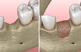 model of the jaw before and after a bone grafting procedure