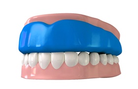 Model of athletic mouthguard over upper teeth.