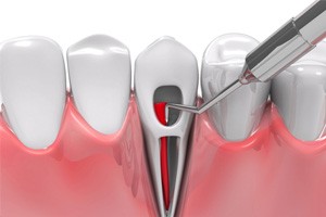 Illustration of root canal therapy in Aurora, CO for the lower arch