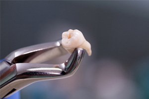 Close-up of an extracted tooth held by forceps