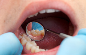 Closeup of tooth being examined