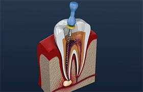  root canal procedure