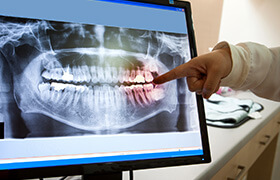 Panoramic dental x-rays