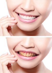 Get a whiter smile today with teeth whitening in Aurora. 