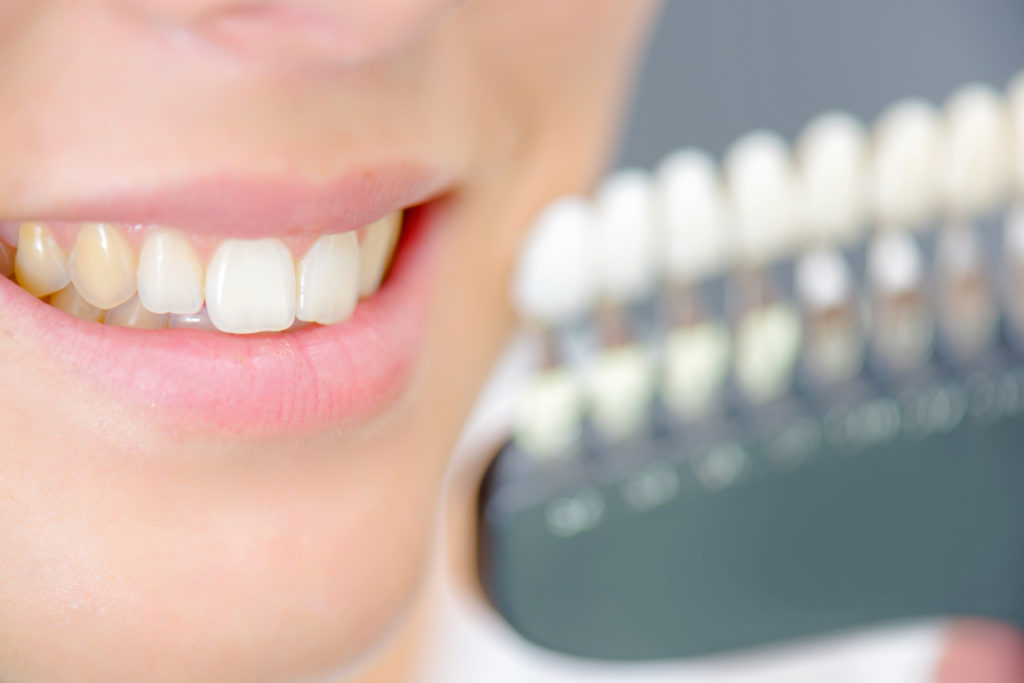 woman smiling posing beside porcelain veneers