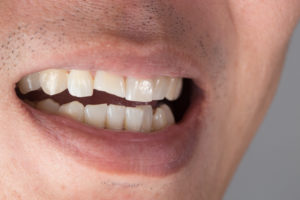 man partially smiling showing cracked tooth