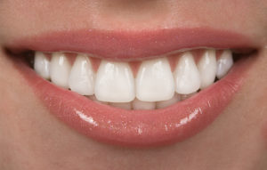 woman with perfectly white teeth