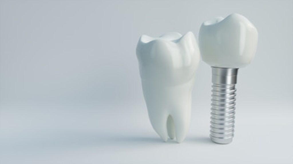 Graphic of a dental implant.